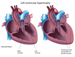 left-ventricular-hypertrophy-anabolic-steroids-570x436.jpg