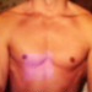 Me,back before i had rotator cuff surgery