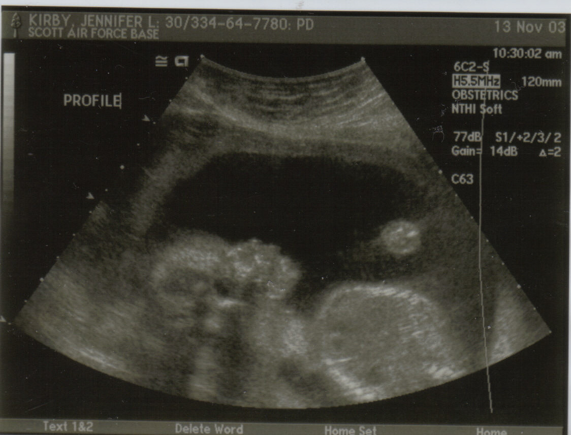 2nd new baby photo