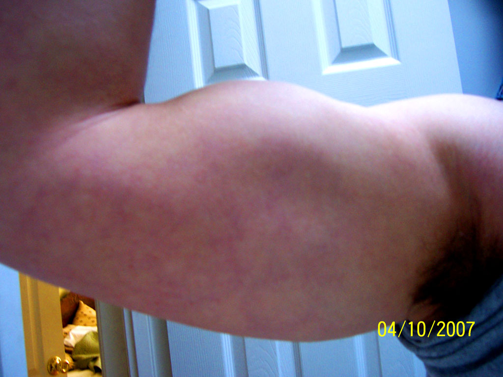 arm