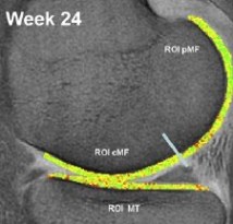 collagenmri5.jpg