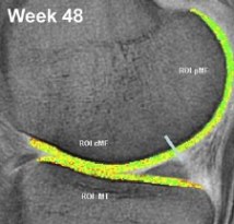 collagenmri6.jpg