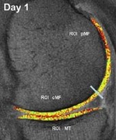 collagenmri.jpg
