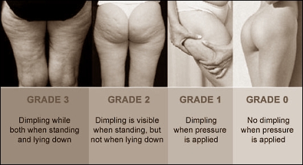 cellulite.jpg