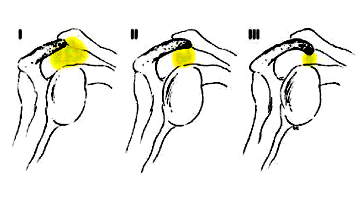 Shoulder sketch