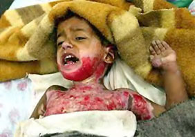 Iraqi-Burned-Injured-Child.jpg