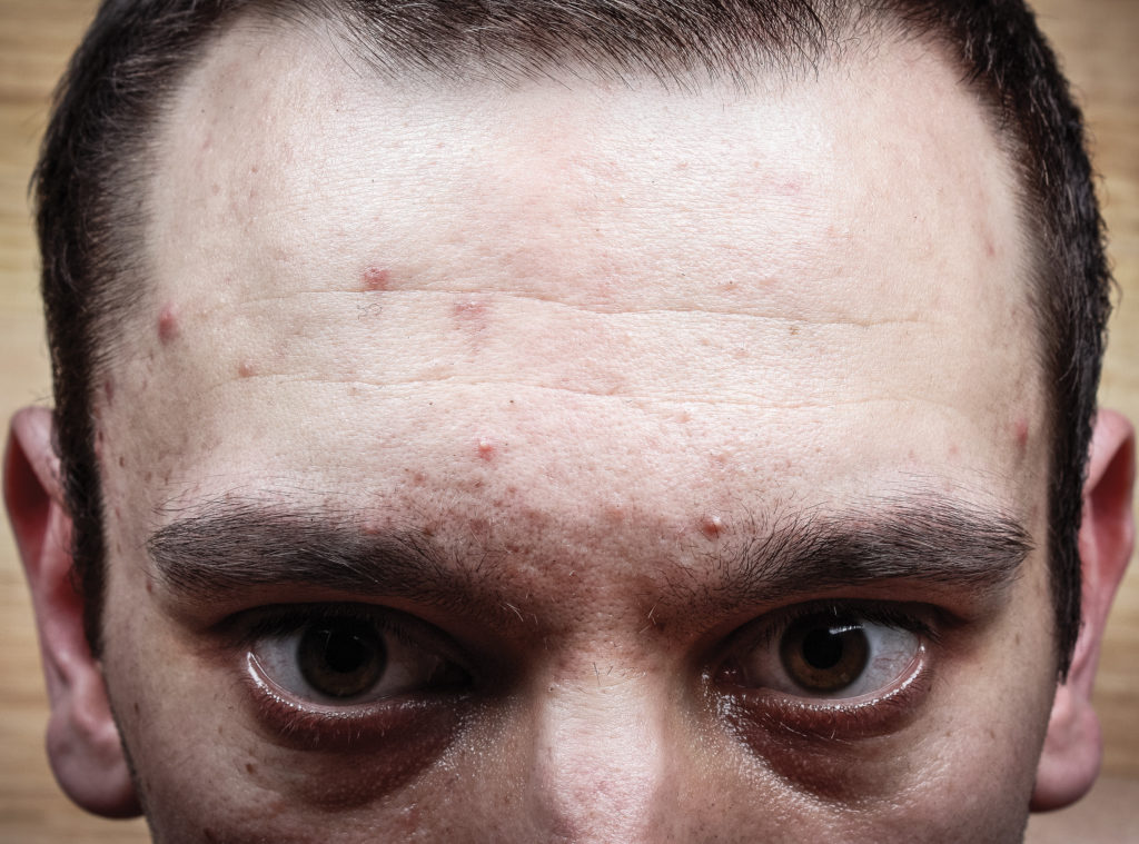 IM0416_ResearchNutrition_pimple_01